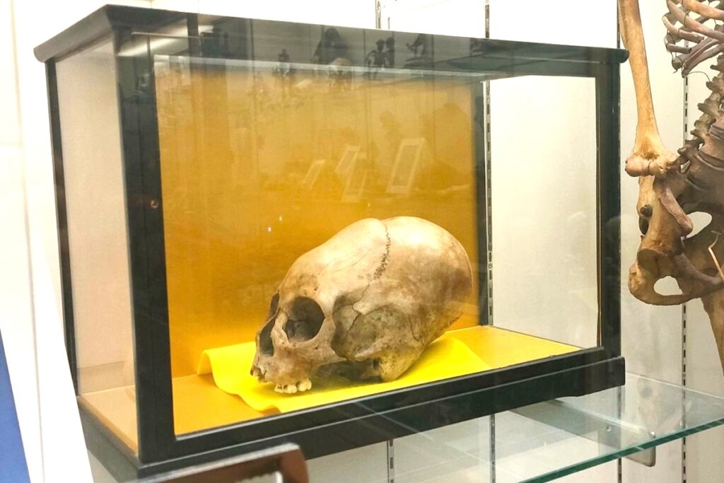 ネパールの変形頭蓋骨